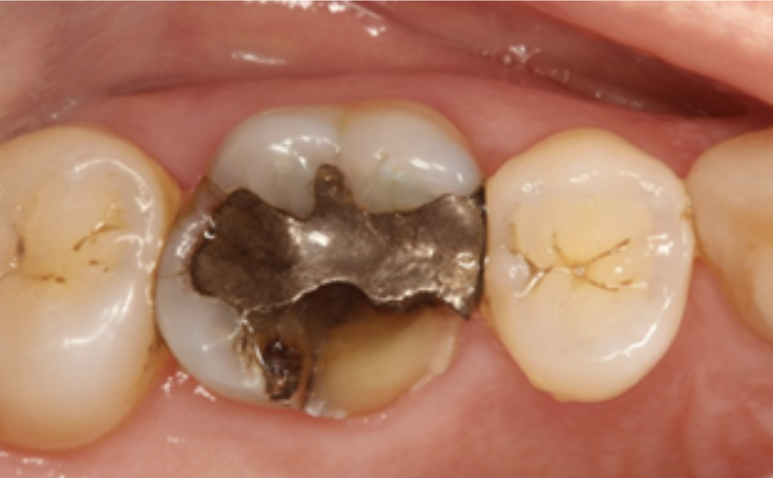 Tanden er knækket på grund af en revne ved siden af en sølvfyldning. Det er en meget hyppig skade.