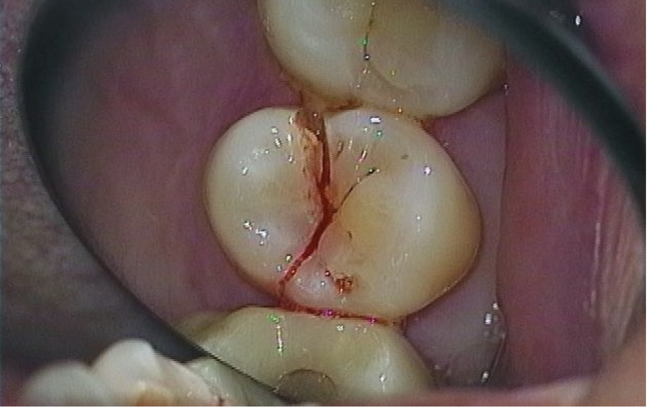 Tand der er flækket på langs på grund af en dyb revne