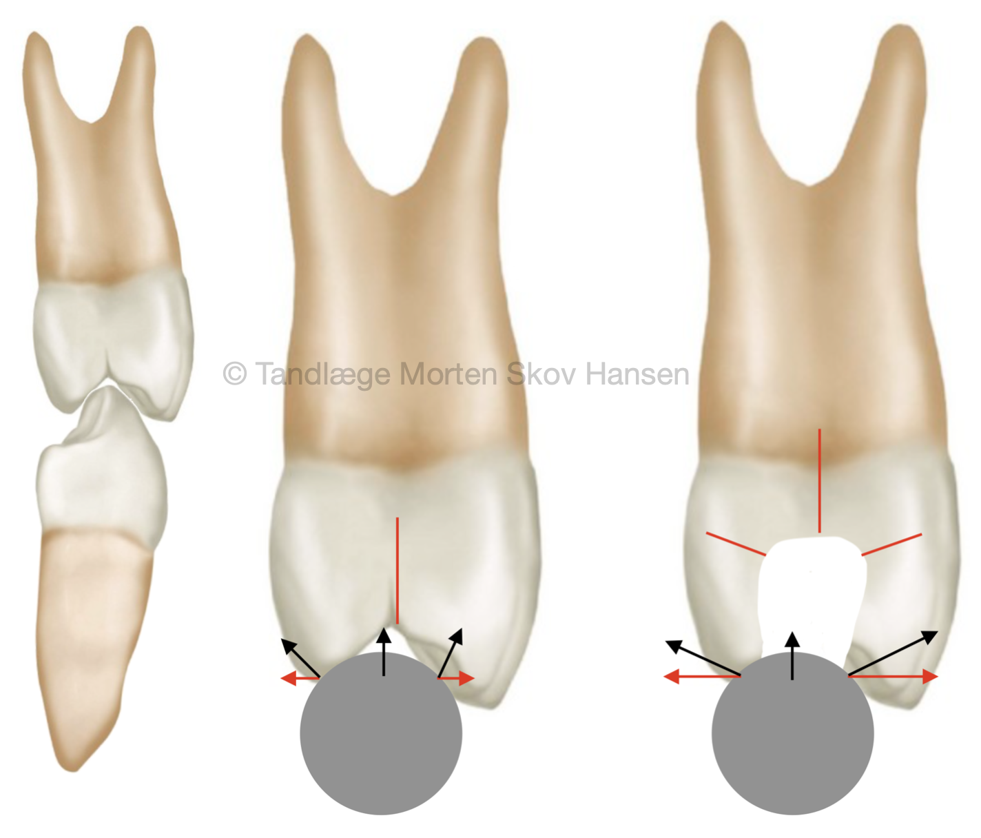 Billede som viser hvordan revner dannes i en tand