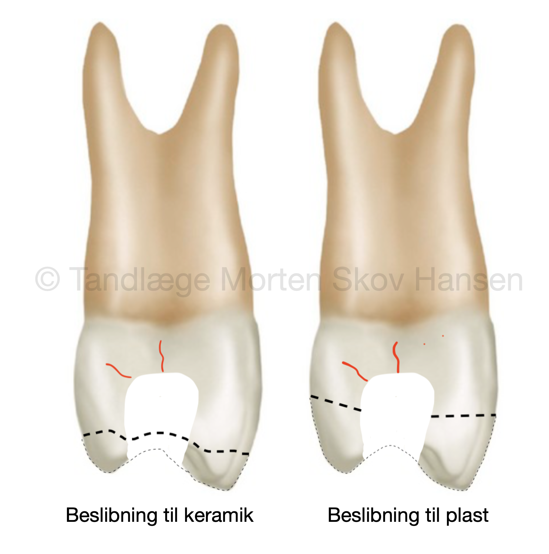 Billedet viser hvor meget der skal slibes væk af en tand for at reparere den med plast eller keramik