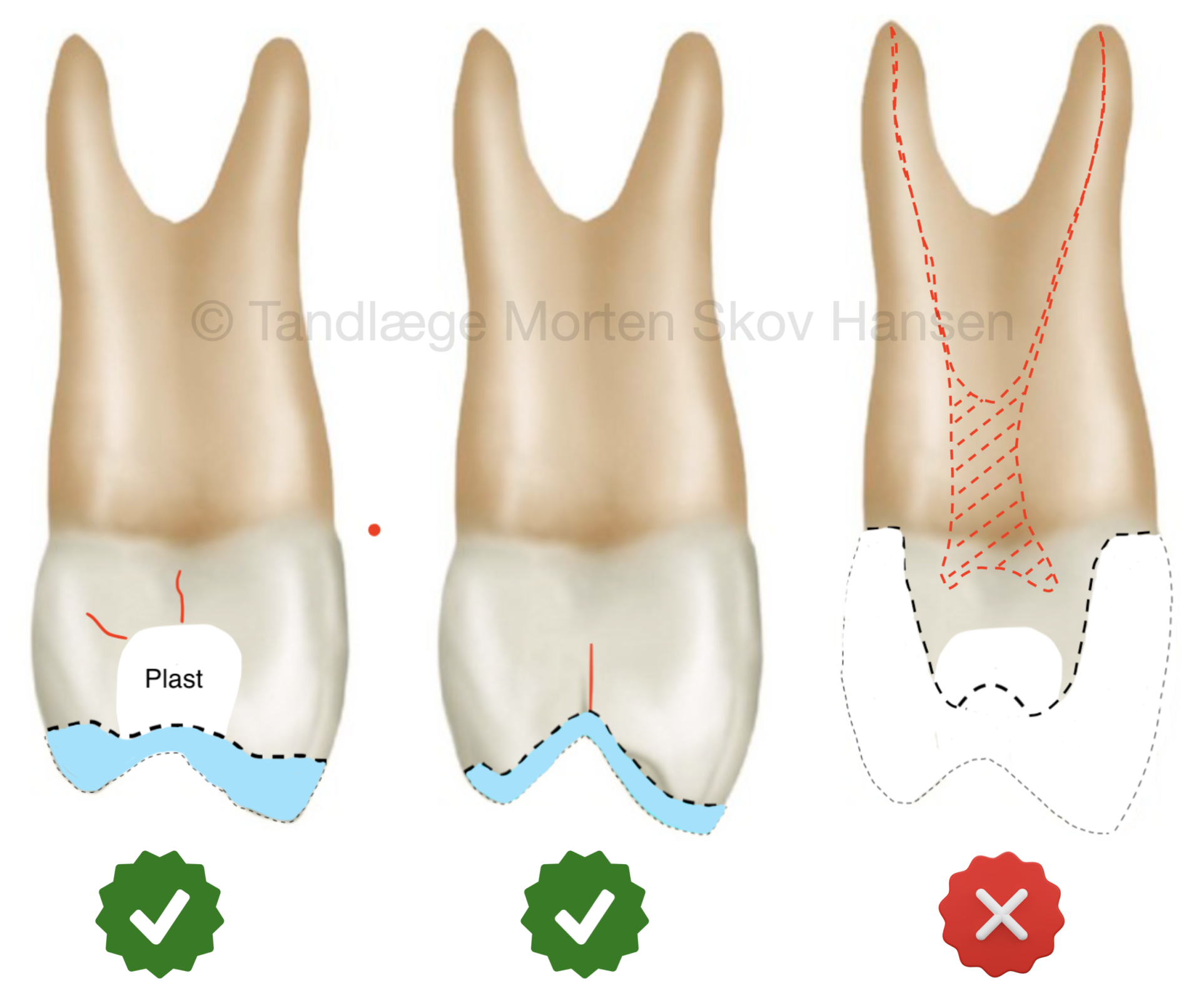 Billedet viser hvordan man bedst restaurerer tænder med keramik