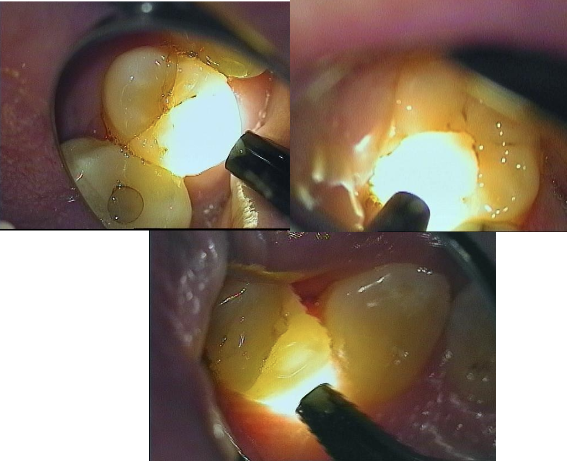 Tænder undersøgt med transillumination