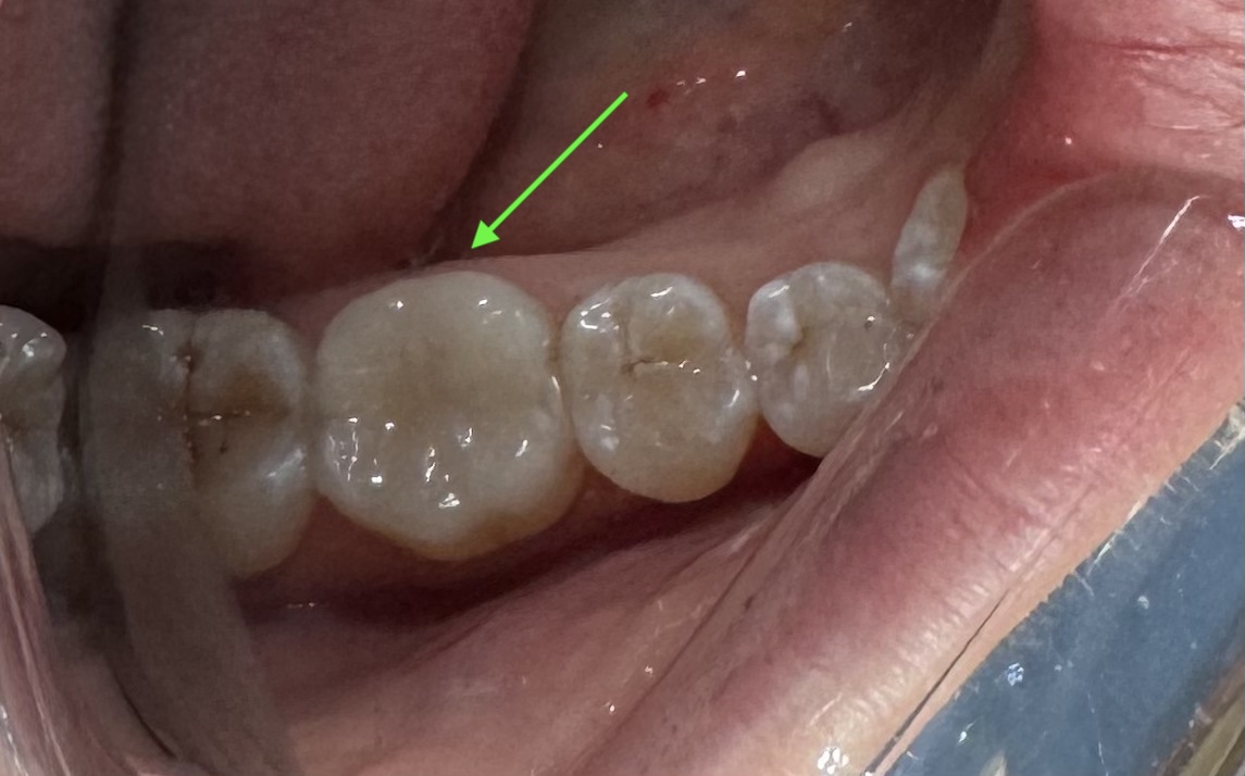 Close-up of lower jaw teeth; the highlighted molar shows a light filling/restoration.